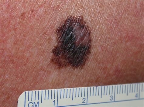 malignt melanom in situ behandling